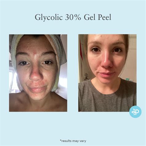 after glycolic peel.